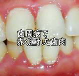 歯周病で赤く腫れた歯肉